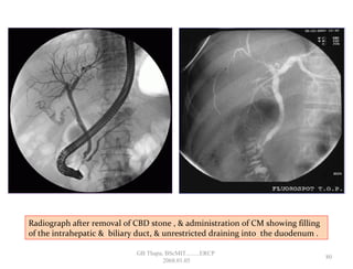 Radiograph after removal of CBD stone , & administration of CM showing filling
of the intrahepatic & biliary duct, & unrestricted draining into the duodenum .
80
GB Thapa, BScMIT.........ERCP
2068.01.05
 