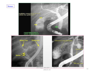 Stones
81
GB Thapa, BScMIT.........ERCP
2068.01.05
 