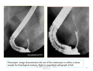 Fluorospot image demonstrates the use of the endoscope to collect a tissue
sample for histological analysis. Right Is magnified radiograph of left.
82
GB Thapa, BScMIT.........ERCP
2068.01.05
 