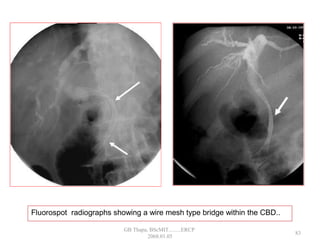 Fluorospot radiographs showing a wire mesh type bridge within the CBD..
83
GB Thapa, BScMIT.........ERCP
2068.01.05
 
