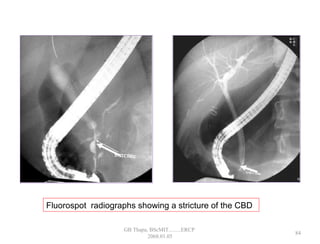 Fluorospot radiographs showing a stricture of the CBD
84
GB Thapa, BScMIT.........ERCP
2068.01.05
 