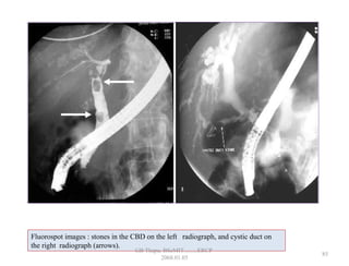 Fluorospot images : stones in the CBD on the left radiograph, and cystic duct on
the right radiograph (arrows).
85
GB Thapa, BScMIT.........ERCP
2068.01.05
 