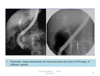 • Fluorospot images demonstrate the main pancreatic duct (duct of Wirsung) of
different patients.
86
GB Thapa, BScMIT.........ERCP
2068.01.05
 