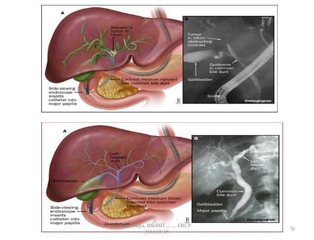 Ercp Approach Is Ercp A Surgery | Endoscopic Retrograde Cholangiopancreatography ...