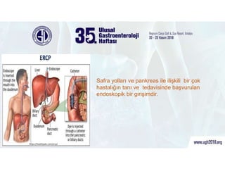 Endoskopik Retrograt Kolanjio Pankreatografi (ERCP)
Safra yolları ve pankreas ile ilişkili bir çok
hastalığın tanı ve tedavisinde başvurulan
endoskopik bir girişimdir.
https://healthjade.com/ercp/
 