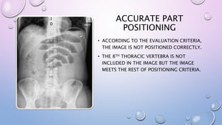 ACCURATE PART
POSITIONING
• ACCORDING TO THE EVALUATION CRITERIA,
THE IMAGE IS NOT POSITIONED CORRECTLY.
• THE 8TH THORACIC VERTEBRA IS NOT
INCLUDED IN THE IMAGE BUT THE IMAGE
MEETS THE REST OF POSITIONING CRITERIA.
1
0
 