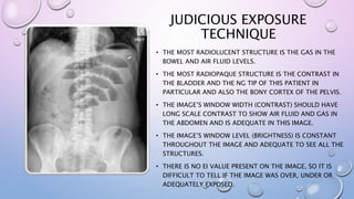 JUDICIOUS EXPOSURE
TECHNIQUE
• THE MOST RADIOLUCENT STRUCTURE IS THE GAS IN THE
BOWEL AND AIR FLUID LEVELS.
• THE MOST RADIOPAQUE STRUCTURE IS THE CONTRAST IN
THE BLADDER AND THE NG TIP OF THIS PATIENT IN
PARTICULAR AND ALSO THE BONY CORTEX OF THE PELVIS.
• THE IMAGE’S WINDOW WIDTH (CONTRAST) SHOULD HAVE
LONG SCALE CONTRAST TO SHOW AIR FLUID AND GAS IN
THE ABDOMEN AND IS ADEQUATE IN THIS IMAGE.
• THE IMAGE’S WINDOW LEVEL (BRIGHTNESS) IS CONSTANT
THROUGHOUT THE IMAGE AND ADEQUATE TO SEE ALL THE
STRUCTURES.
• THERE IS NO EI VALUE PRESENT ON THE IMAGE, SO IT IS
DIFFICULT TO TELL IF THE IMAGE WAS OVER, UNDER OR
ADEQUATELY EXPOSED.
 