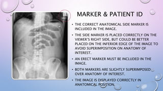MARKER & PATIENT ID
• THE CORRECT ANATOMICAL SIDE MARKER IS
INCLUDED IN THE IMAGE.
• THE SIDE MARKER IS PLACED CORRECTLY ON THE
VIEWER’S RIGHT SIDE, BUT COULD BE BETTER
PLACED ON THE INFERIOR EDGE OF THE IMAGE TO
AVOID SUPERIMPOSITION ON ANATOMY OF
INTEREST.
• AN ERECT MARKER MUST BE INCLUDED IN THE
IMAGE.
• BOTH MARKERS ARE SLIGHTLY SUPERIMPOSED
OVER ANATOMY OF INTEREST.
• THE IMAGE IS DISPLAYED CORRECTLY IN
ANATOMICAL POSITION.
 