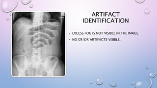 ARTIFACT
IDENTIFICATION
• EXCESS FOG IS NOT VISIBLE IN THE IMAGE.
• NO CR/DR ARTIFACTS VISIBLE.
 