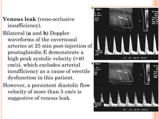 Venous leak (veno-occlusive
  insufficiency).
Bilateral (a and b) Doppler
  waveforms of the cavernosal
  arteries at 25 min post-injection of
  prostaglandin E demonstrate a
  high peak systolic velocity (>40
  cm/s), which excludes arterial
  insufficiency as a cause of erectile
  dysfunction in this patient.
However, a persistent diastolic flow
  velocity of more than 5 cm/s is
  suggestive of venous leak.
 