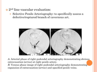    2nd line vascular evaluation:
       Selective Penile Arteriography: to specifically assess a
        defective/ruptured branch of cavernous art.




A. Arterial phase of right pudendal arteriography demonstrating obvious
extravasation (arrow) at right penile artery.
B. Venous phase image of right pudendal arteriography demonstrating
expansion of extravasation (arrow) and opacified penile veins.
 