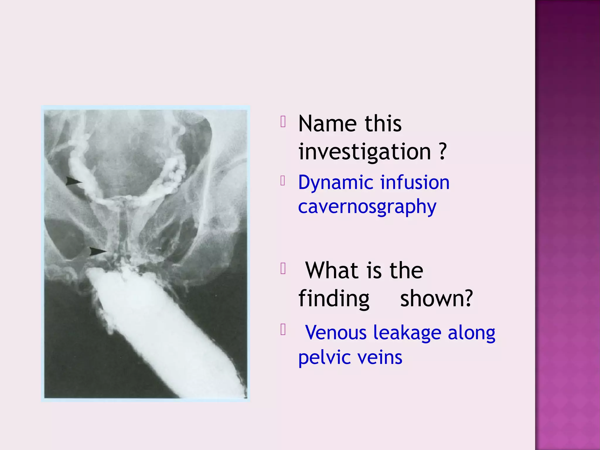 Name this
investigation ?
 Dynamic infusion
cavernosgraphy
 What is the
finding shown?
 Venous leakage along
pelvic veins
 