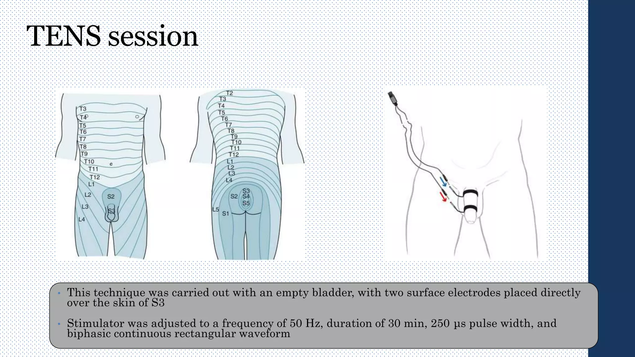 TENS session
• This technique was carried out with an empty bladder, with two surface electrodes placed directly
over the skin of S3
• Stimulator was adjusted to a frequency of 50 Hz, duration of 30 min, 250 μs pulse width, and
biphasic continuous rectangular waveform
 