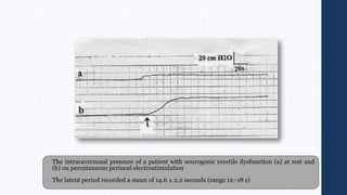 • The intracavernosal pressure of a patient with neurogenic erectile dysfunction (a) at rest and
(b) on percutaneous perineal electrostimulation
• The latent period recorded a mean of 14.6 ± 2.2 seconds (range 12–18 s)
 