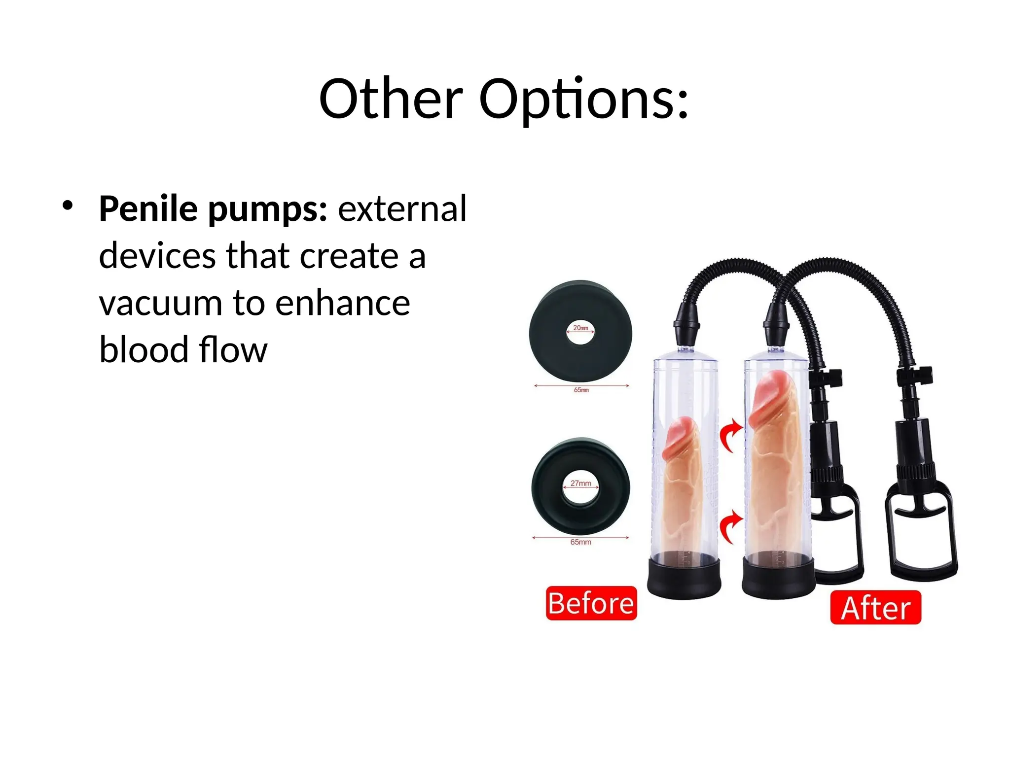 Other Options:
• Penile pumps: external
devices that create a
vacuum to enhance
blood flow
 