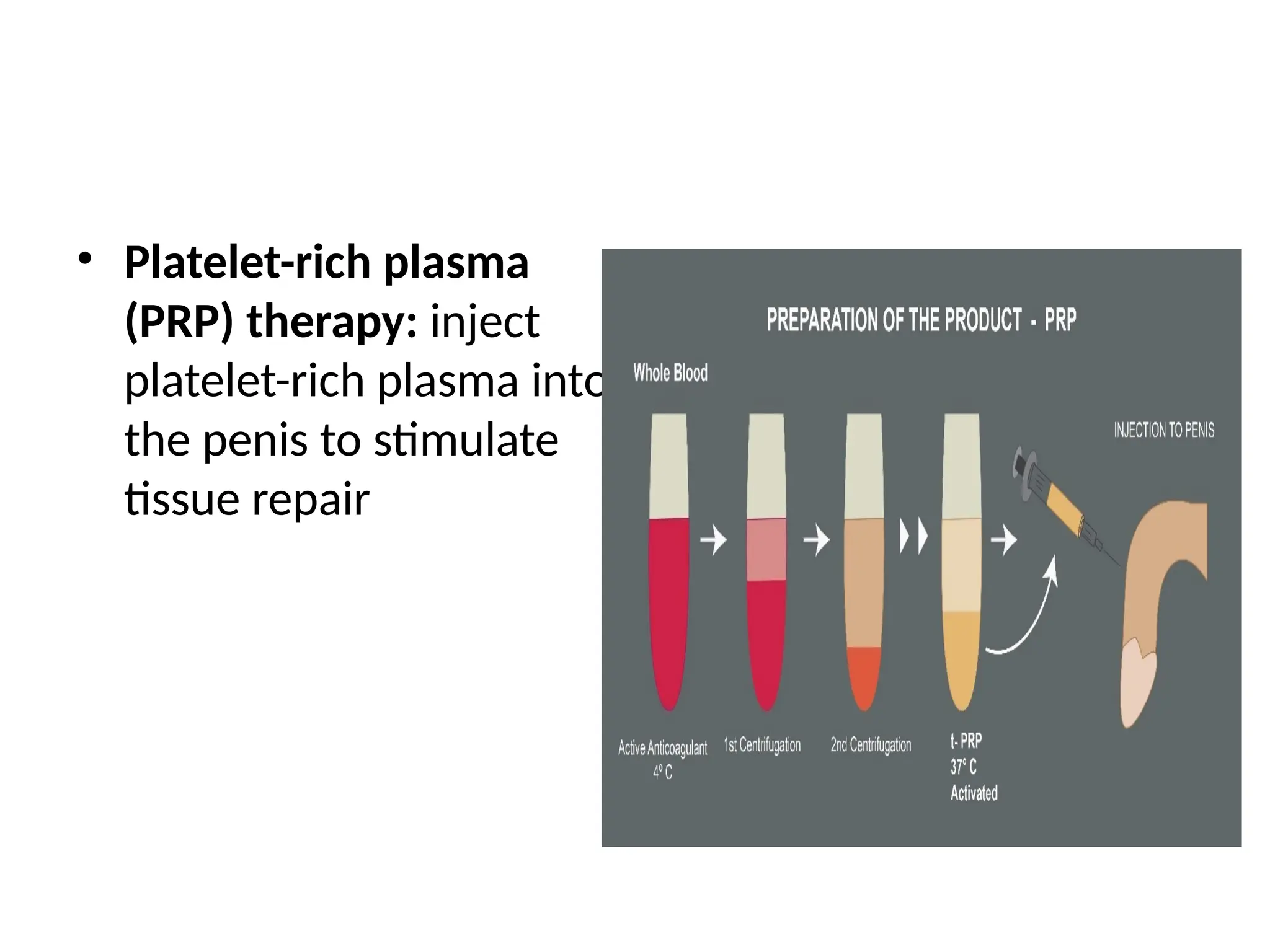 • Platelet-rich plasma
(PRP) therapy: inject
platelet-rich plasma into
the penis to stimulate
tissue repair
 