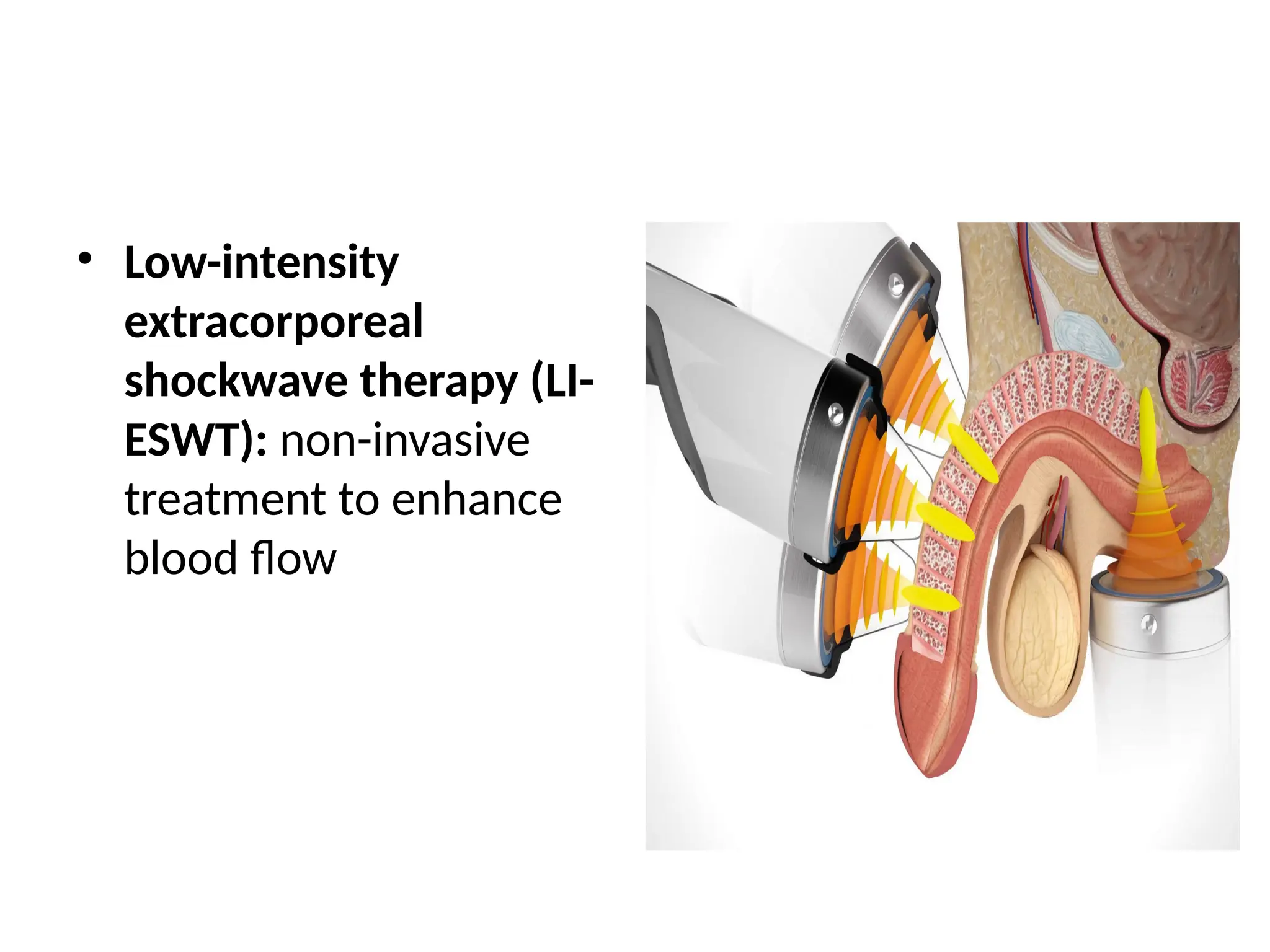 • Low-intensity
extracorporeal
shockwave therapy (LI-
ESWT): non-invasive
treatment to enhance
blood flow
 