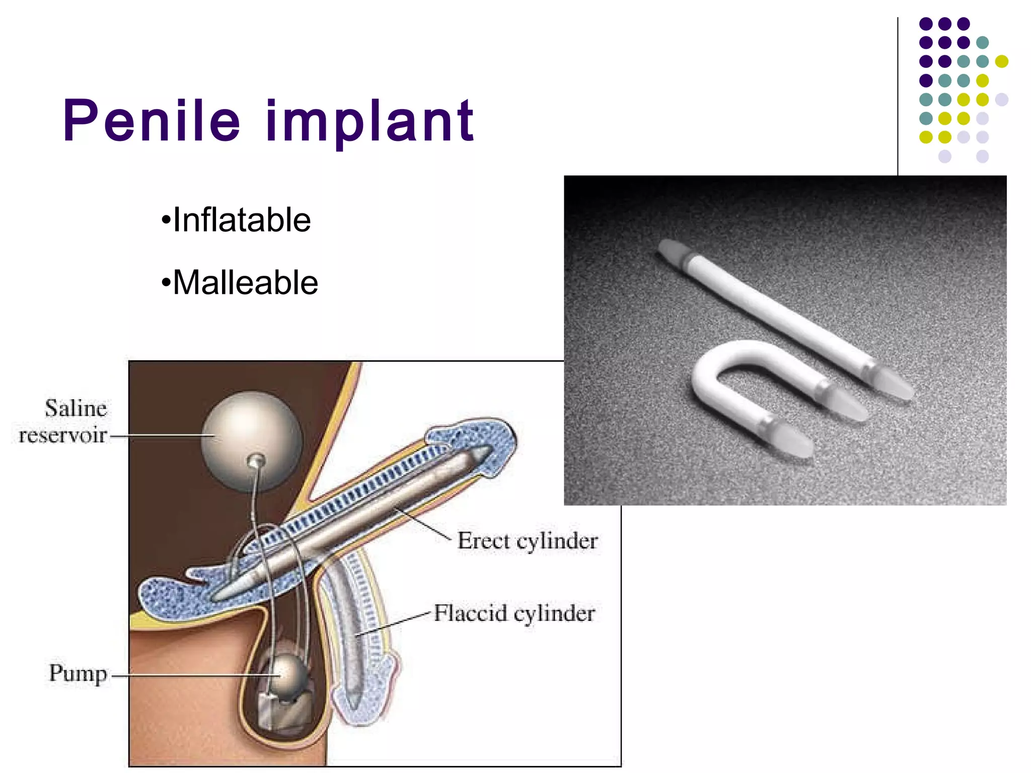 Penile implant Inflatable Malleable 