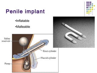 Penile implant Inflatable Malleable 