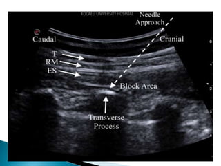 Espb Block Erector spinae plane block for pain management | PPTX