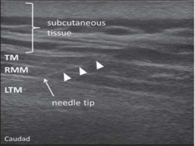 Erector spinae plane block for pain management | PPTX