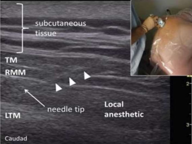 Erector spinae plane block for pain management | PPTX