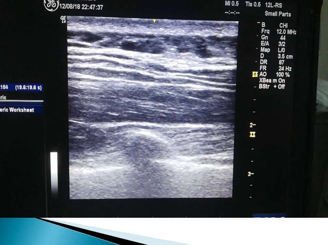 Erector spinae plane block for pain management | PPTX