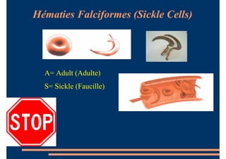 Hématies Falciformes (Sickle Cells)
A= Adult (Adulte)
S= Sickle (Faucille)