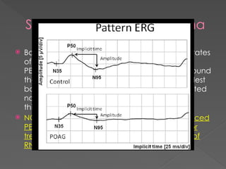 Pattern Erg Rgc ERG electroretinogram principle,methods,measurement parameters,diseases ...