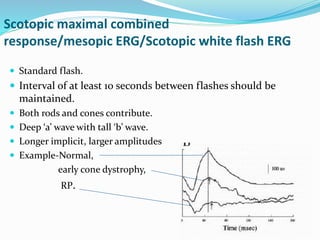 Scotopic maximal combined
response/mesopic ERG/Scotopic white flash ERG
 Standard flash.
 Interval of at least 10 seconds between flashes should be
maintained.
 Both rods and cones contribute.
 Deep ‘a’ wave with tall ‘b’ wave.
 Longer implicit, larger amplitudes
 Example-Normal,
early cone dystrophy,
RP.
 