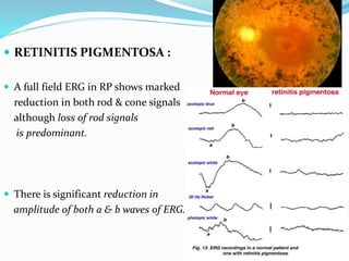  RETINITIS PIGMENTOSA :
 A full field ERG in RP shows marked
reduction in both rod & cone signals
although loss of rod signals
is predominant.
 There is significant reduction in
amplitude of both a & b waves of ERG.
 