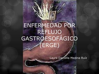 ENFERMEDAD POR
     REFLUJO
GASTROESOFÁGICO
      (ERGE)

       Laura Daniella Medina Ruíz
 