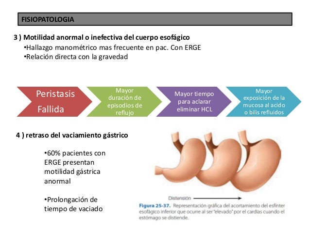 ENFERMEDAD POR REFLUJO GASTROESOFAGICO