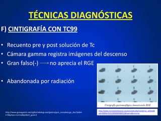 TÉCNICAS DIAGNÓSTICAS
F) CINTIGRAFÍA CON TC99
• Recuento pre y post solución de Tc
• Cámara gamma registra imágenes del descenso
• Gran falso(-) no aprecia el RGE
• Abandonada por radiación
http://www.revistasbolivianas.org.bo/scielo.php?script=sci_arttext&
pid=S0004-05252009000300013&lng=es&nrm=isohttp://www.guiasgastro.net/cgibin/wbdcgi.exe/gastro/guis_completa.go_doc?piden
t=5&ptipo=normal&pident_guia=2
 