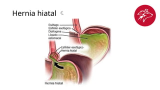 Hernia hiatal 
 