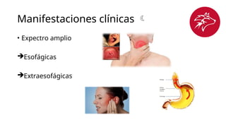 Manifestaciones clínicas 
• Expectro amplio
Esofágicas
Extraesofágicas
 