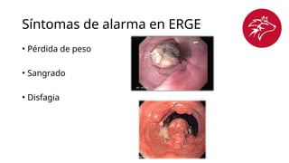 Síntomas de alarma en ERGE
• Pérdida de peso
• Sangrado
• Disfagia
 
