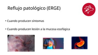 Reflujo patológico (ERGE)
• Cuando producen síntomas
• Cuando producen lesión a la mucosa esofágica
 