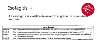 Esofagitis 
• La esofagitis se clasifica de acuerdo al grado de lesión de la
mucosa.
 