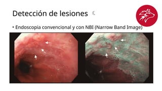 Detección de lesiones 
• Endoscopia convencional y con NBI (Narrow Band Image)
 