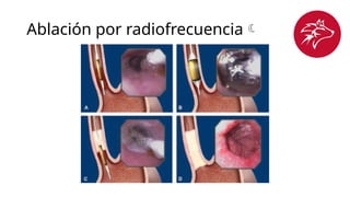 Ablación por radiofrecuencia
 