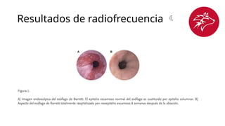 Resultados de radiofrecuencia 
 
