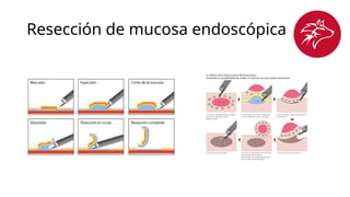 Resección de mucosa endoscópica 
 