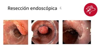 Resección endoscópica 
 