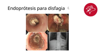 Endoprótesis para disfagia 
 