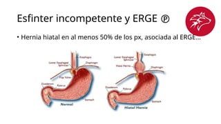 Esfinter incompetente y ERGE 
• Hernia hiatal en al menos 50% de los px, asociada al ERGE…
 