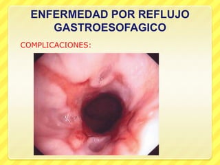 ENFERMEDAD POR REFLUJO
GASTROESOFAGICO
COMPLICACIONES:
 