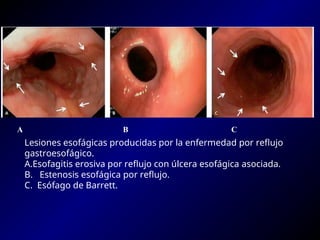 ERGE Y ENFEMEDAD ACIDO PEPTICA.ppt con cuadro clinico , diagnostico y ...