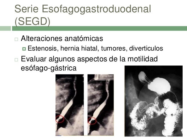 Erge y hernia hiatal Erge y hernia hiatal