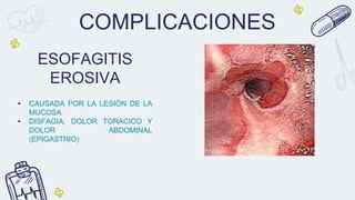 COMPLICACIONES
• CAUSADA POR LA LESIÓN DE LA
MUCOSA
• DISFAGIA. DOLOR TORACICO Y
DOLOR ABDOMINAL
(EPIGASTRIO)
ESOFAGITIS
EROSIVA
 
